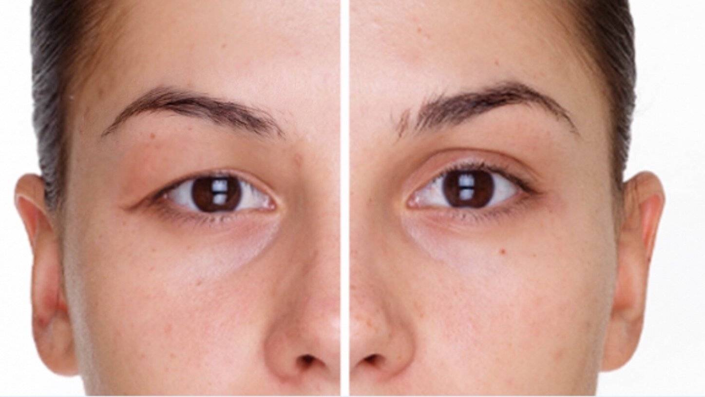 dr akyol goz kapaklarindaki sarkmalar gorme guclugune yol acabiliyor kNeHjzZj