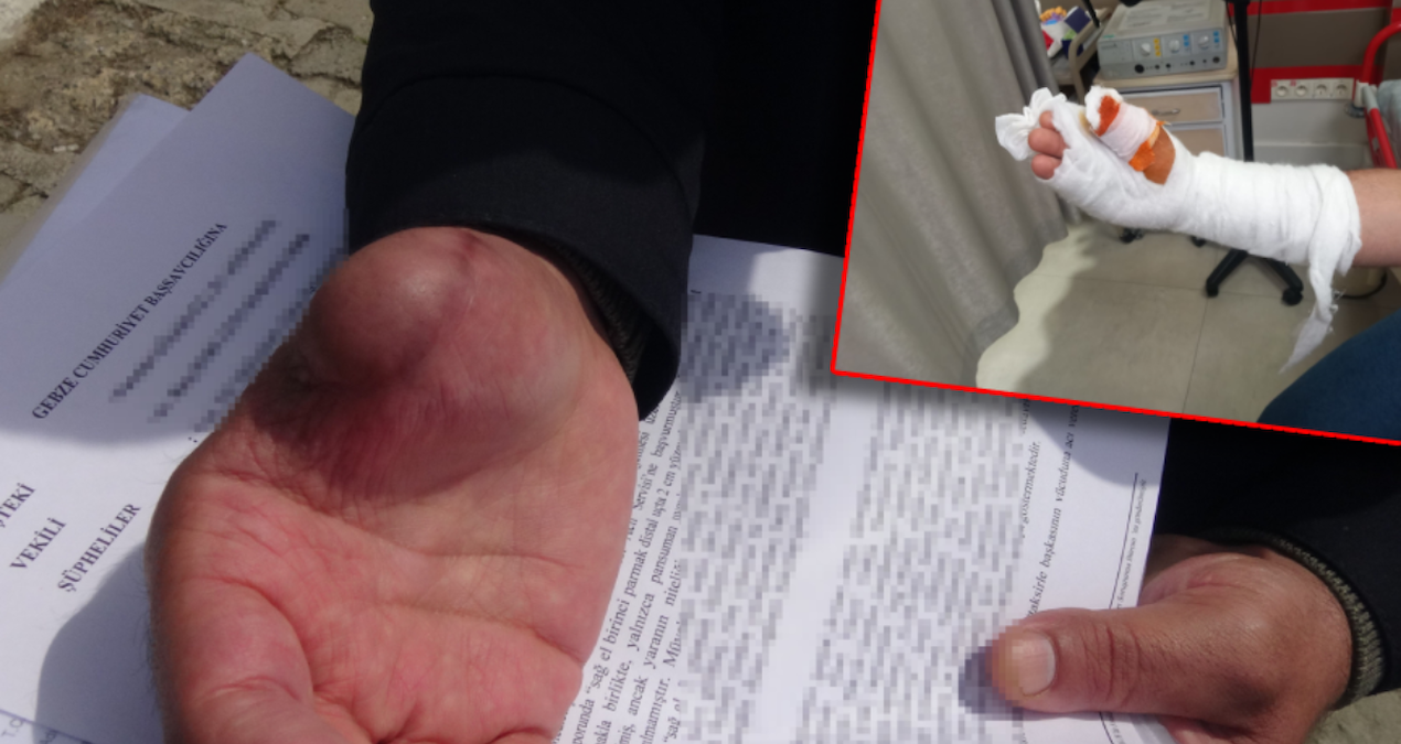 İhmaller Sonucu Hayatı Kararan Adam: ‘Parmağım Çürümeye Başladı’